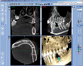 Aufnahmen eines DVT – 3D-Röntgen in der Software-Ansicht in unserer Zanarztpraxis in Essen