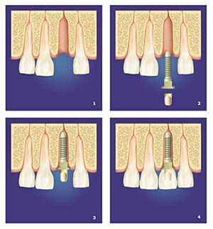 implantologie – Zahnimplantate in der Zahnarztpraxis Essen – Zahnarzt Essen